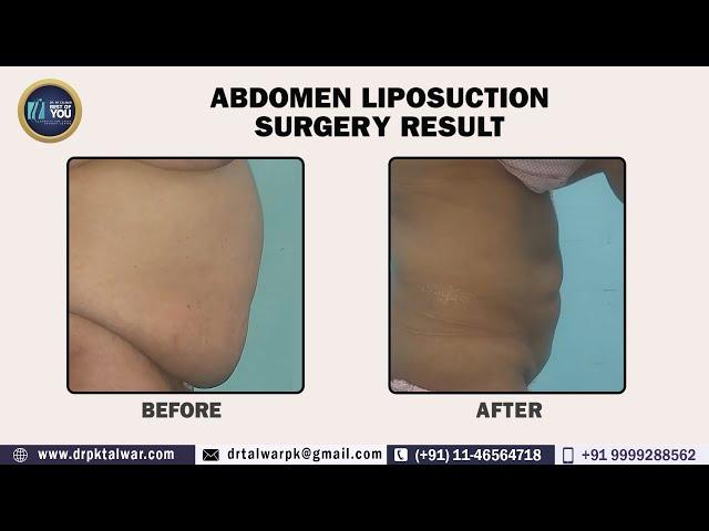 Liposuction Surgery  Procedure and its Results I Before-After Results of Abdominal Liposuction