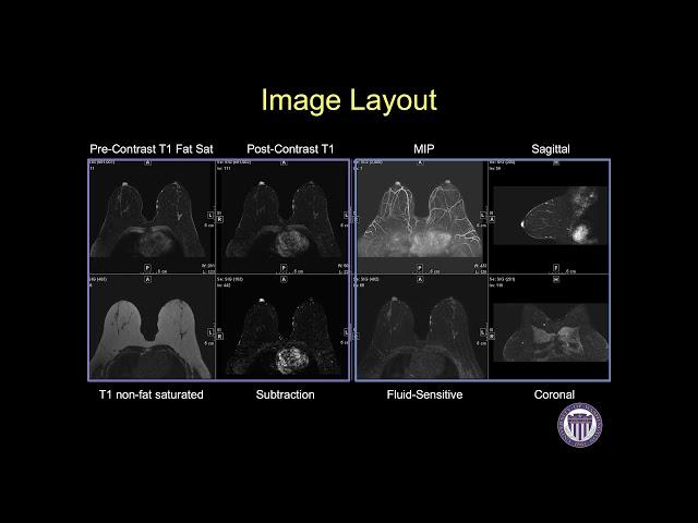 Breast MRI