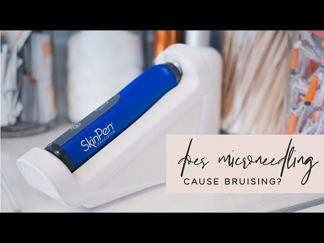 Microneedling FAQ: Does microneedling cause bruising or swelling? - Skin by Lovely