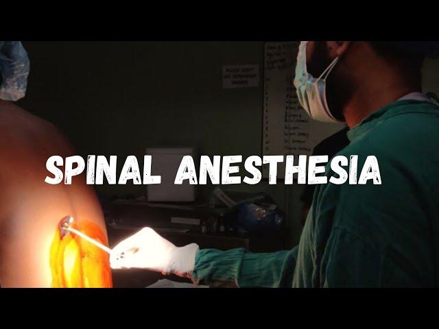 How to give spinal anesthesia ? LEARN IN 1 MINUTE