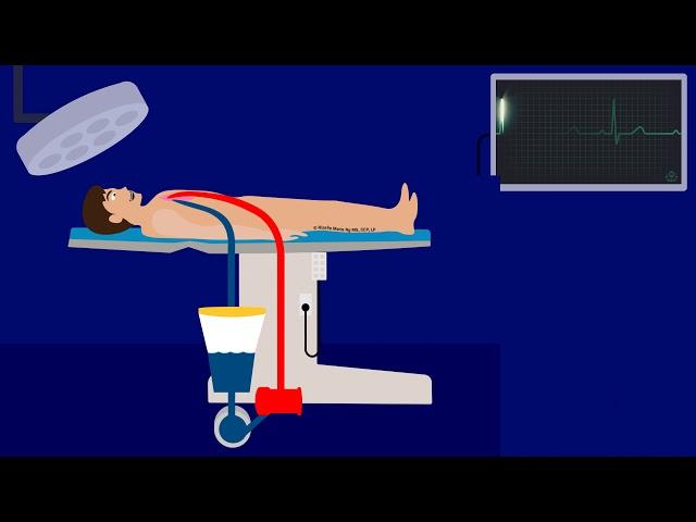 ECMO VS CPB