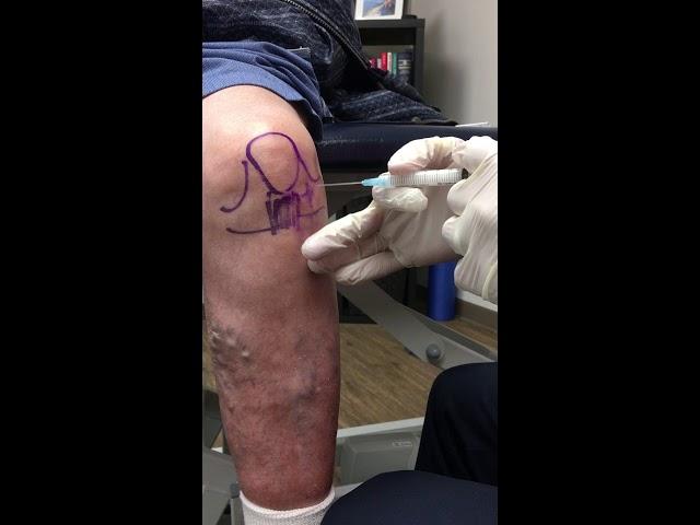 Anterior Knee Injection - Elite Sports Medicine - Lethbridge