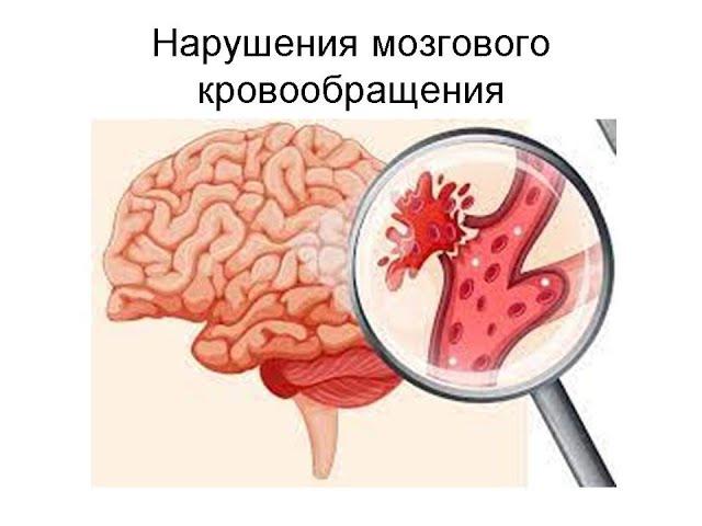 Нарушения мозгового кровообращения