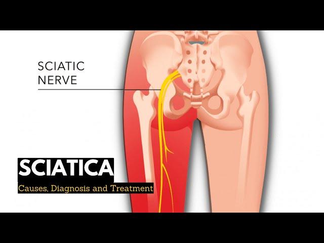 Sciatica, Causes, Signs and Symptoms, Diagnosis and Treatment