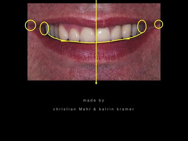 The golden rules of aesthetic smile & what factors affect them? // Case of the Month