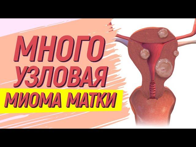 Многоузловая миома матки  Удалить нельзя лечить