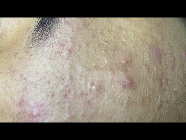 Acne treatment for Spa Linh Mun 2023 #095