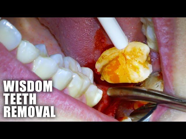 Full Wisdom Teeth Removal Procedure! Emergency Extraction of Impacted & Partially Erupted Molar