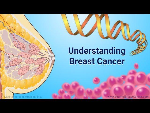 Understanding Breast Cancer