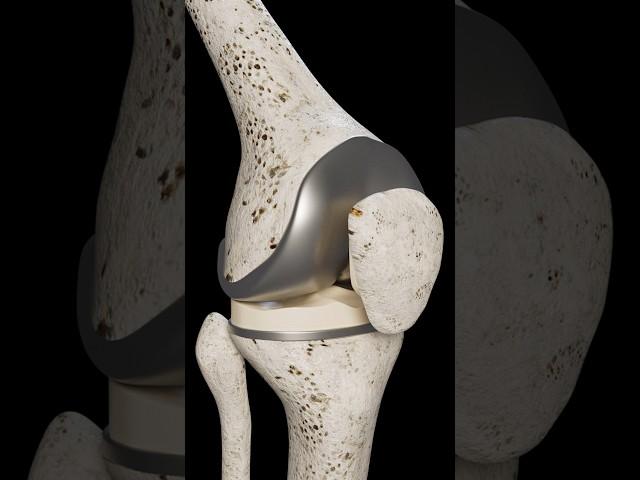 Total Knee Replacement