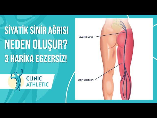 Siyatik Sinir Ağrısı Neden Oluşur? | 3 Harika Egzersiz!