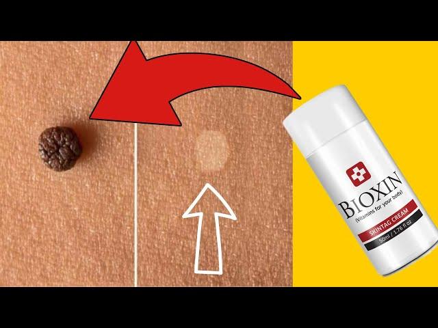 Skin Tag Removers Reviews - BIOXIN SKIN TAG REMOVAL