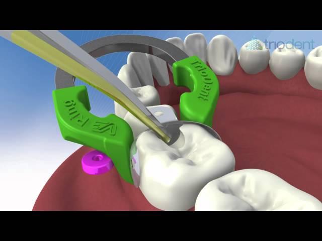 Class II composite restoration using V3 Sectional Matrix System - Triodent