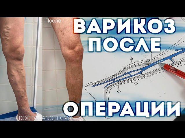 ПОЧЕМУ ВАРИКОЗ МОЖЕТ ВЕРНУТЬСЯ ПОСЛЕ ЛАЗЕРНОГО УДАЛЕНИЯ ВЕН? КОНСУЛЬТАЦИЯ