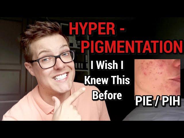 HYPERPIGMENTATION - 100% Effective Treatments (What Brands Wont Tell You)