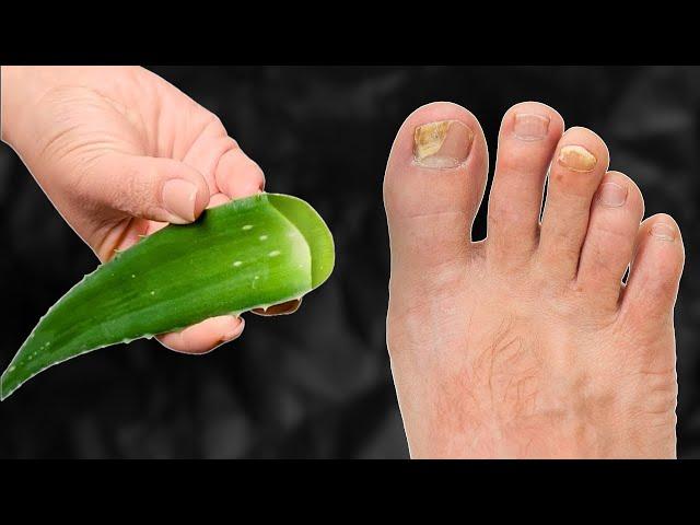  Eliminates toenail fungus IMMEDIATELY! The best remedy! Benefits of aloe! 