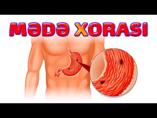 MƏDƏ XORASI / MƏDƏ AĞRILARI / MƏDƏ YARASI / MƏDƏDƏ QASTİRİT / qastroenteroloq