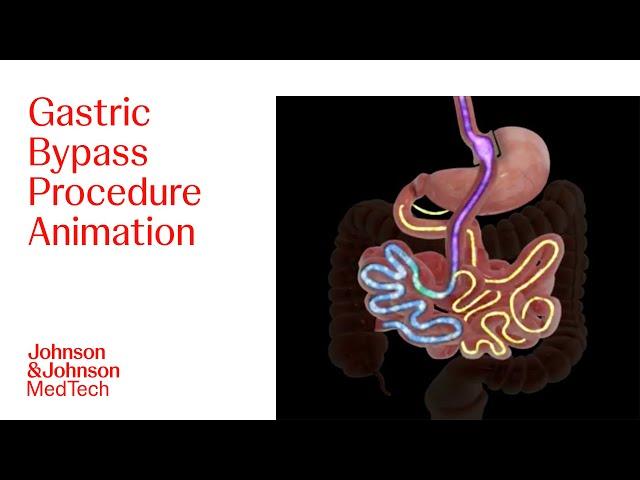 Gastric Bypass Procedure Animation