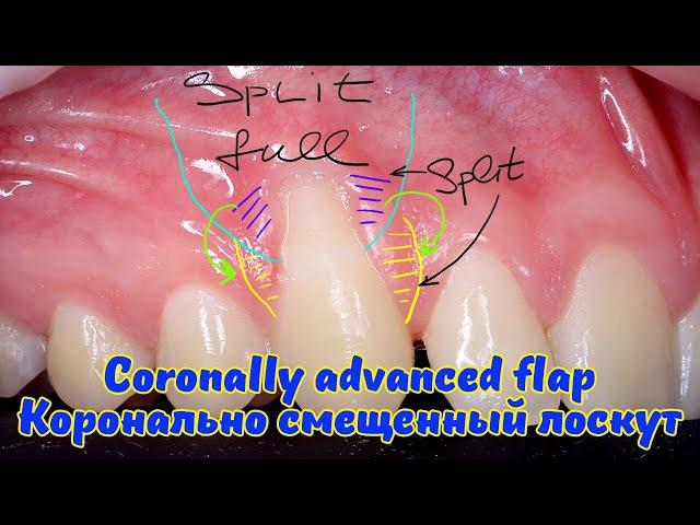 Лечение рецессии десны методом КСЛ // Coronally advanced flap for single gum recession treatment