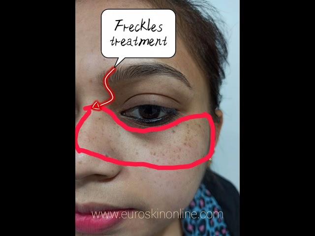 Freckles Removal Treatment