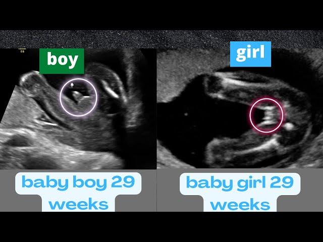 Ultrasound Showing a Boy and a Girl Baby Both at 29 Weeks