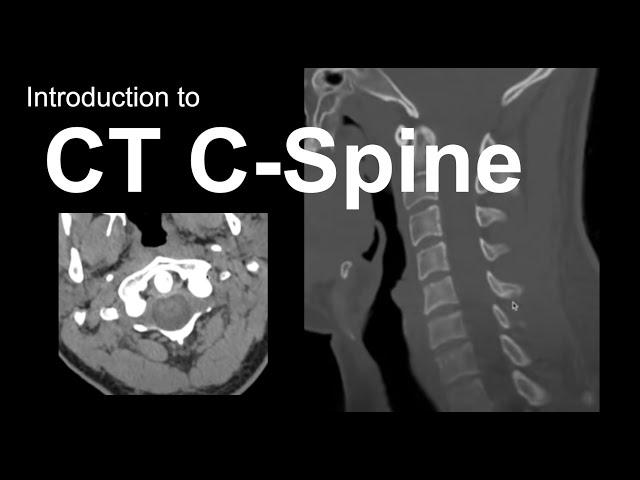 Introduction to CT C-spine: Approach and Essentials