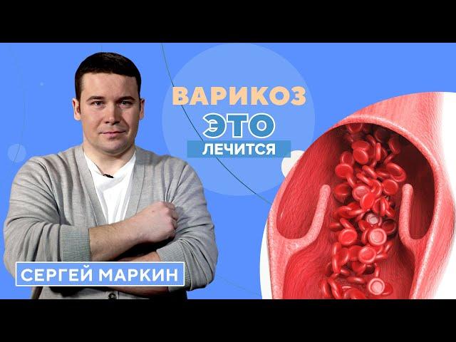 Все о варикозе: виды, профилактика, эффективные методы лечения