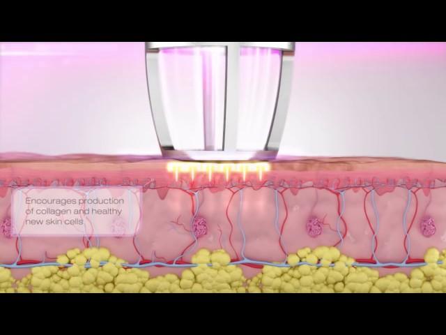 CO2RE Fractional CO2 Laser Skin Resurfacing - Facial Rejuvenation NYC