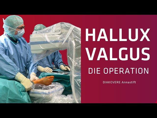 Operation eines Hallux Valgus: Minimalinvasiver Eingriff im DIAKOVERE Annastift Hannover