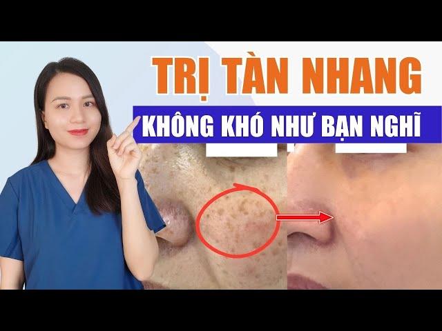 Tàn nhang là gì? Điều trị tàn nhang không khó như bạn nghĩ với 4 bước đơn giản này| Nguyễn Mai Hương