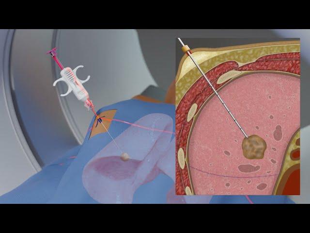 Lung Tumor Biopsy