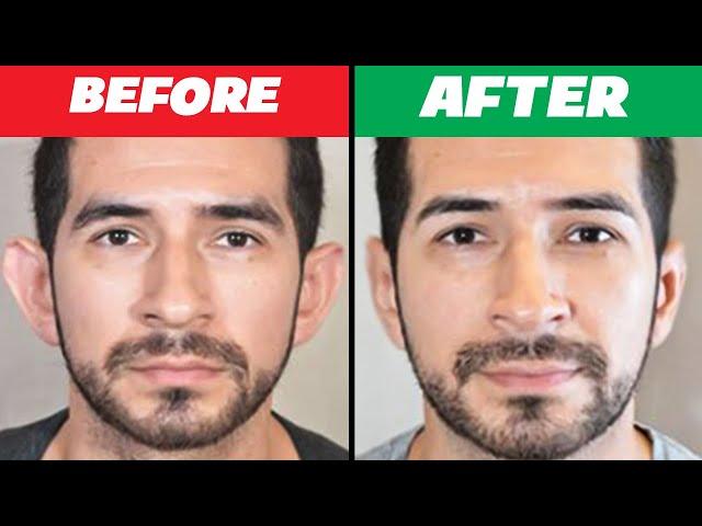 Only 2 mins!! minimize large ears without surgery & tool, protruding ears,