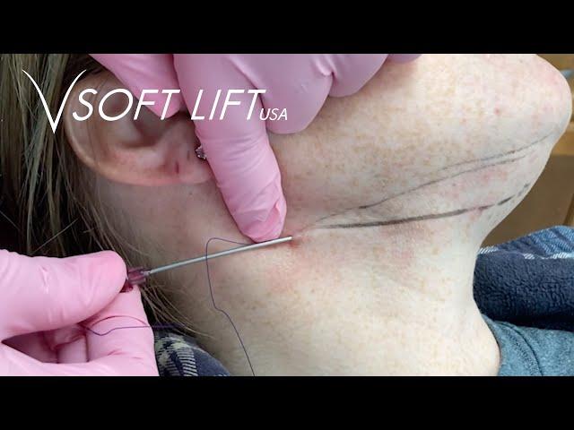 Neck Lift Using PDO Lifting Threads