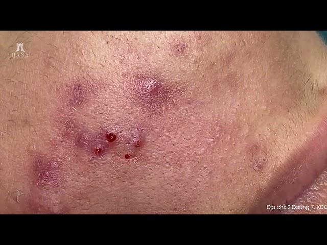 Big Cystic Acne Blackheads Extraction Blackheads & Milia, Whiteheads Removal Pimple Popping