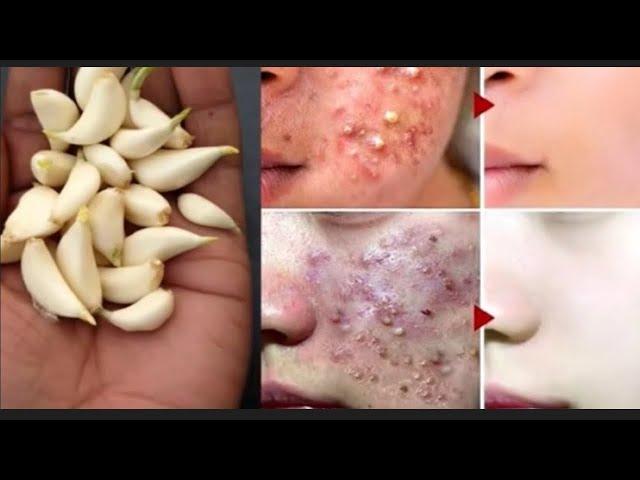 Pimples removal on face pimples removal home remedy|Acne new 2025|acne treatment at home