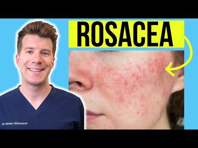 Doctor explains ROSACEA | Skin Condition - Causes, Treatment and more!