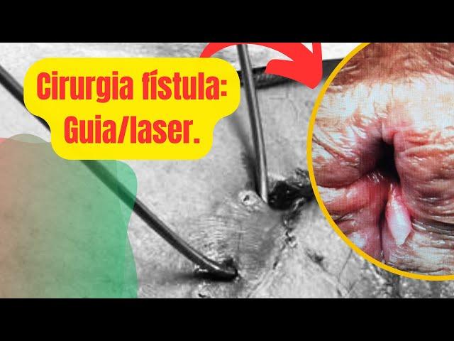 Fazendo cirurgia fístula perianal c/meu guia metálico e anestesia local e sem internação  37 anos: