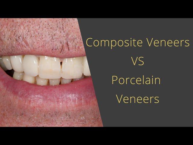 Composite Teeth Veneers Vs. Porcelain Veneers