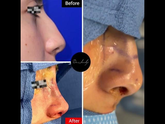 Rhinoplasty immediate results with Dr. Boom Boom Pow