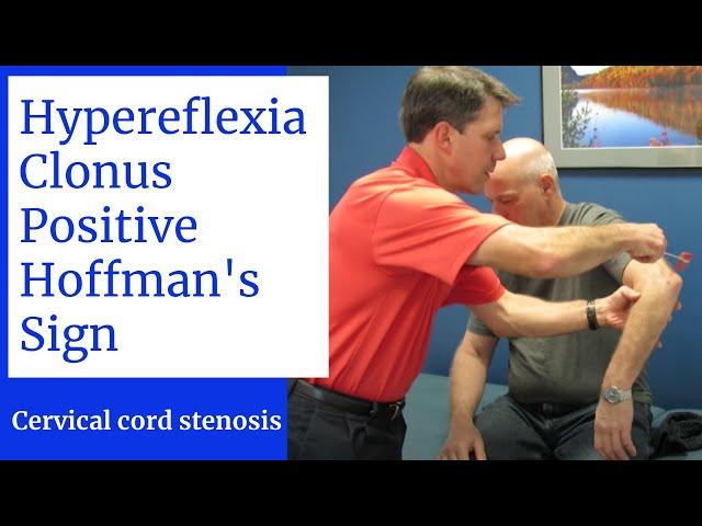 Hyperreflexia, Clonus, Positive Hoffman's Sign- Central Cervical Spine Stenosis