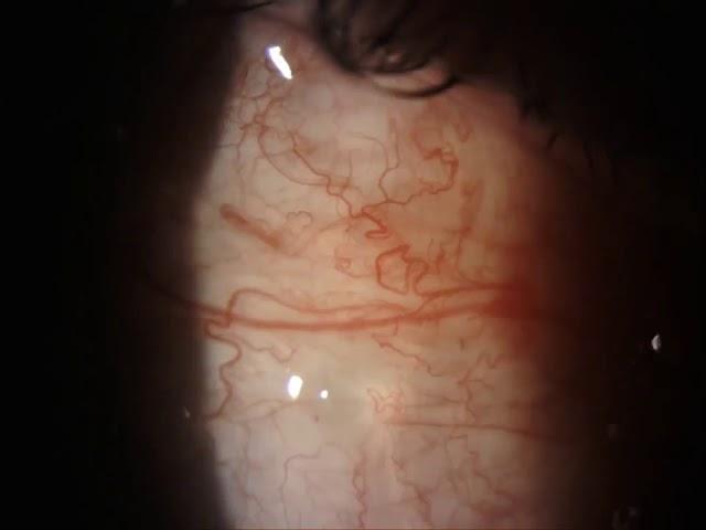 Sub conjunctival foreign body