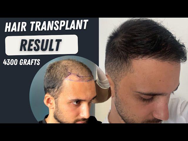 Hair Transplant Result 4300 grafts l Before and After 10 months l Hair Transplant in Turkey