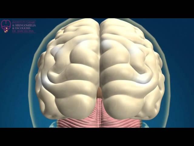 Institut Chiari & Siringomielia & Escoliosis de Barcelona