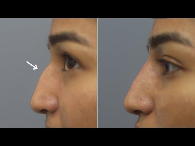 Nonsurgical rhinoplasty in India  | 15 minutes non surgical rhinoplasty at Cara clinic Mumbai.