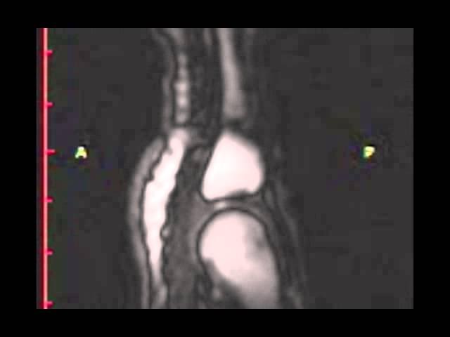 Real-time MRI of joint cracking