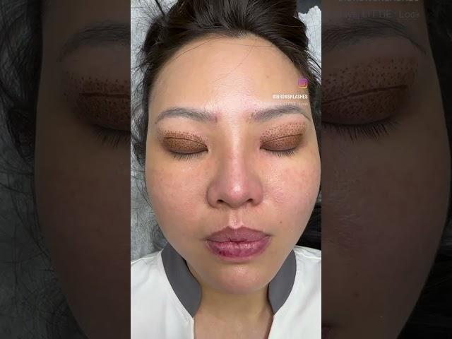 Fixing previous eyelid surgery by plasma by Hannah