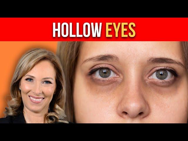 Tips for Hollow Eyes | Dr. Janine