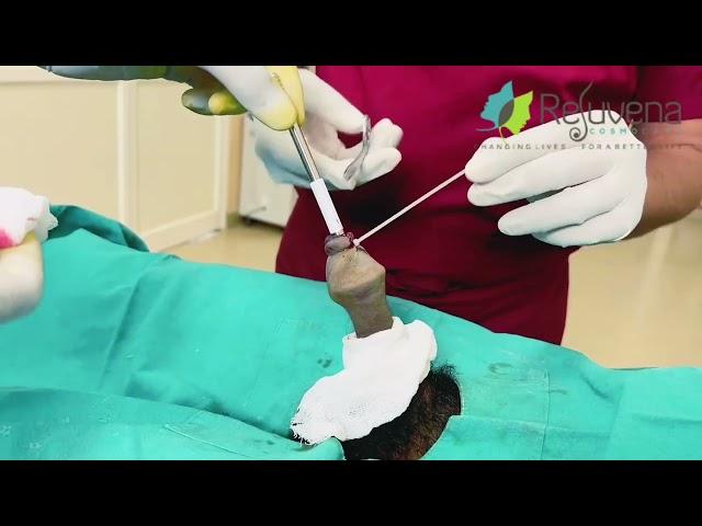 Successful Circumcision Procedure by Dr. Deepesh Goyal at Rejuvena Cosmo Care