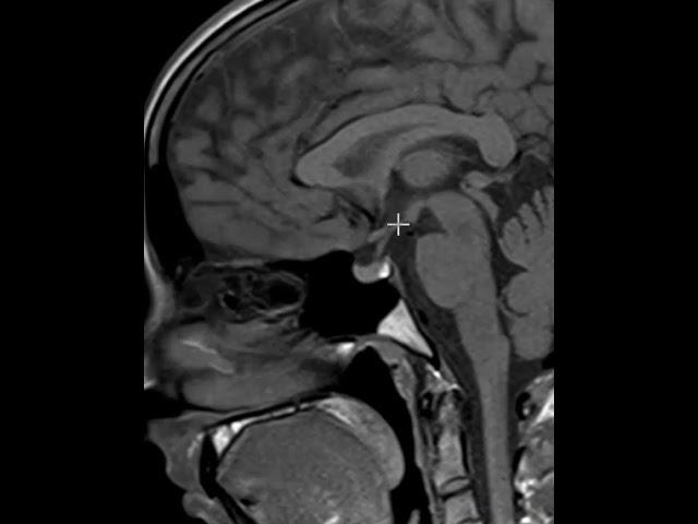 How to read an MRI of the pituitary gland | First Look MRI