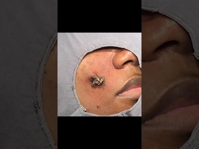 A deceivingly cheeky cyst ️️ #drpimplepopper #popaholics #oddlysatisfying